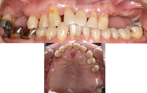上顎臼歯部のインプラント治療 参考例